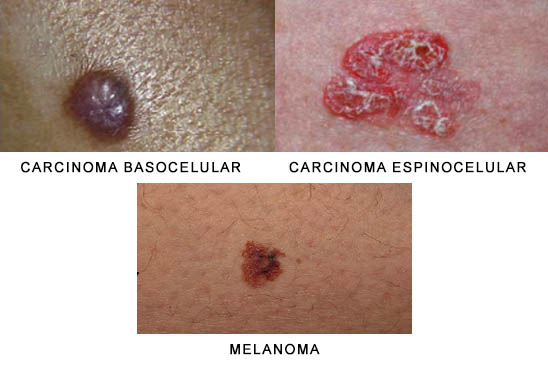 melanoma_carcionoma_basocel·lular_carcioma_espinocelular